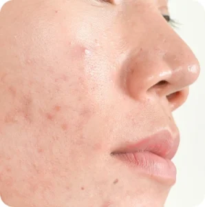 Acne-Scars-Cica-Glocalcare-Healing-298x300