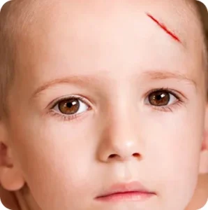 Laceration-Scars-Cica-Glocalcare-healing-298x300