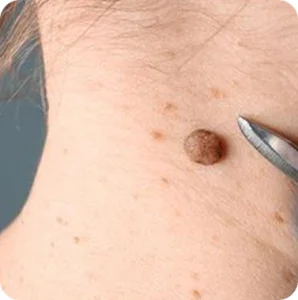 Mole-Removal-Scars-Cica-Glocalcare-298x300