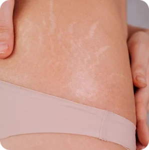Stretch-Marks-Cica-Glocal-healing-1-298x300