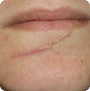 Trauma-Scars-Cica-glocalcare-healing-298x300
