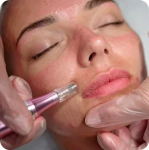 microneedling-scar-Cica-Glocal-healing-298x300